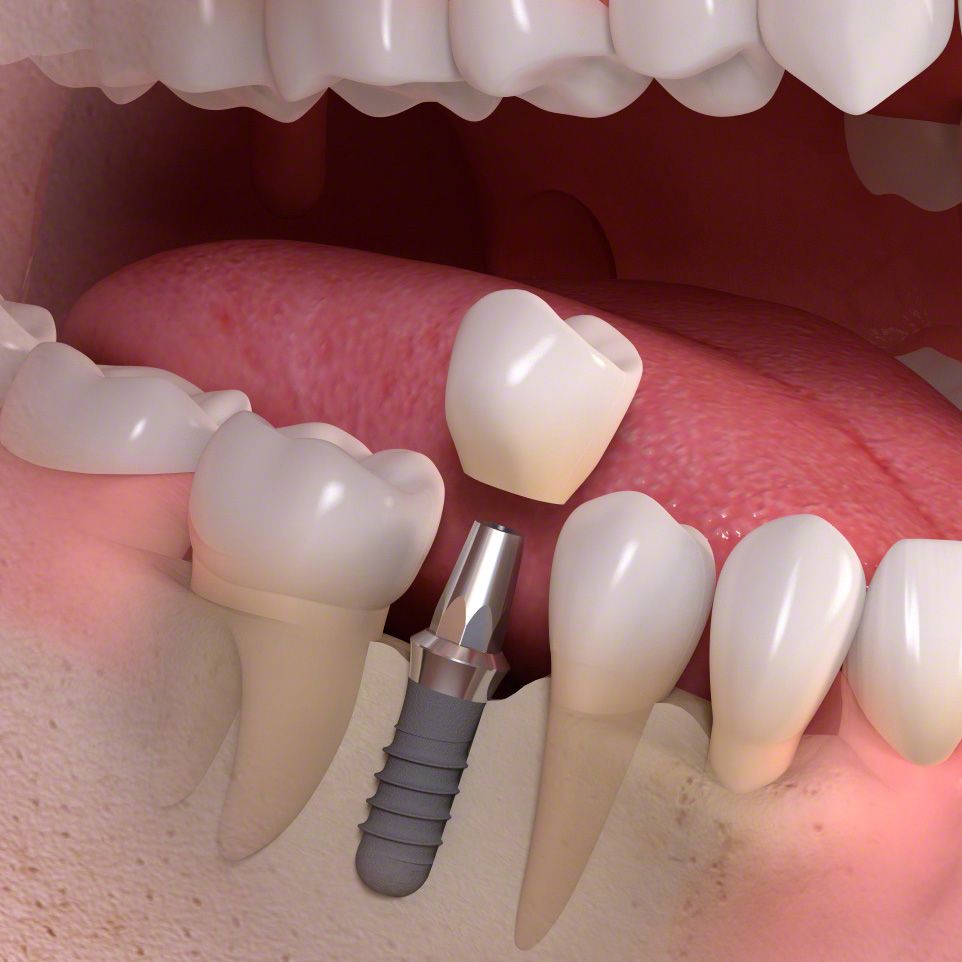 dental implant procedure